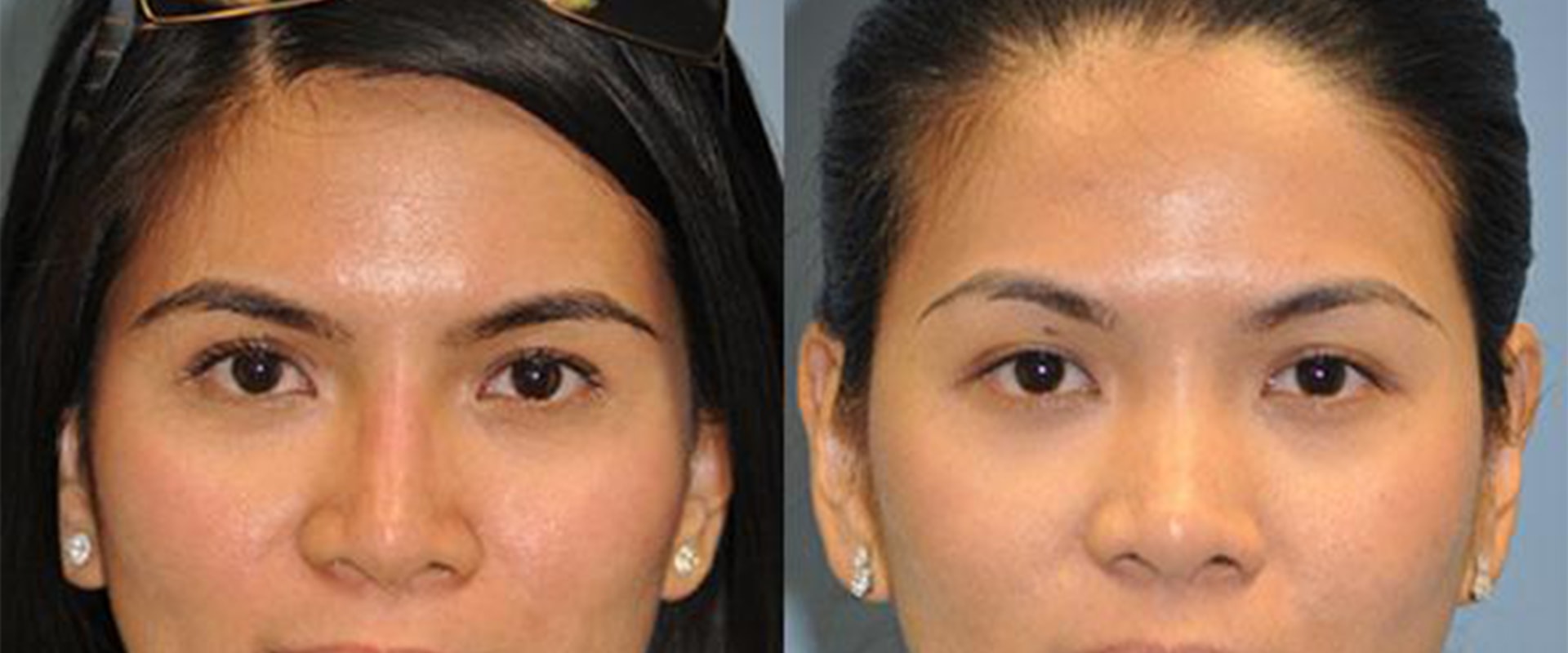 The Truth About the Longevity of Non-Surgical Nose Correction