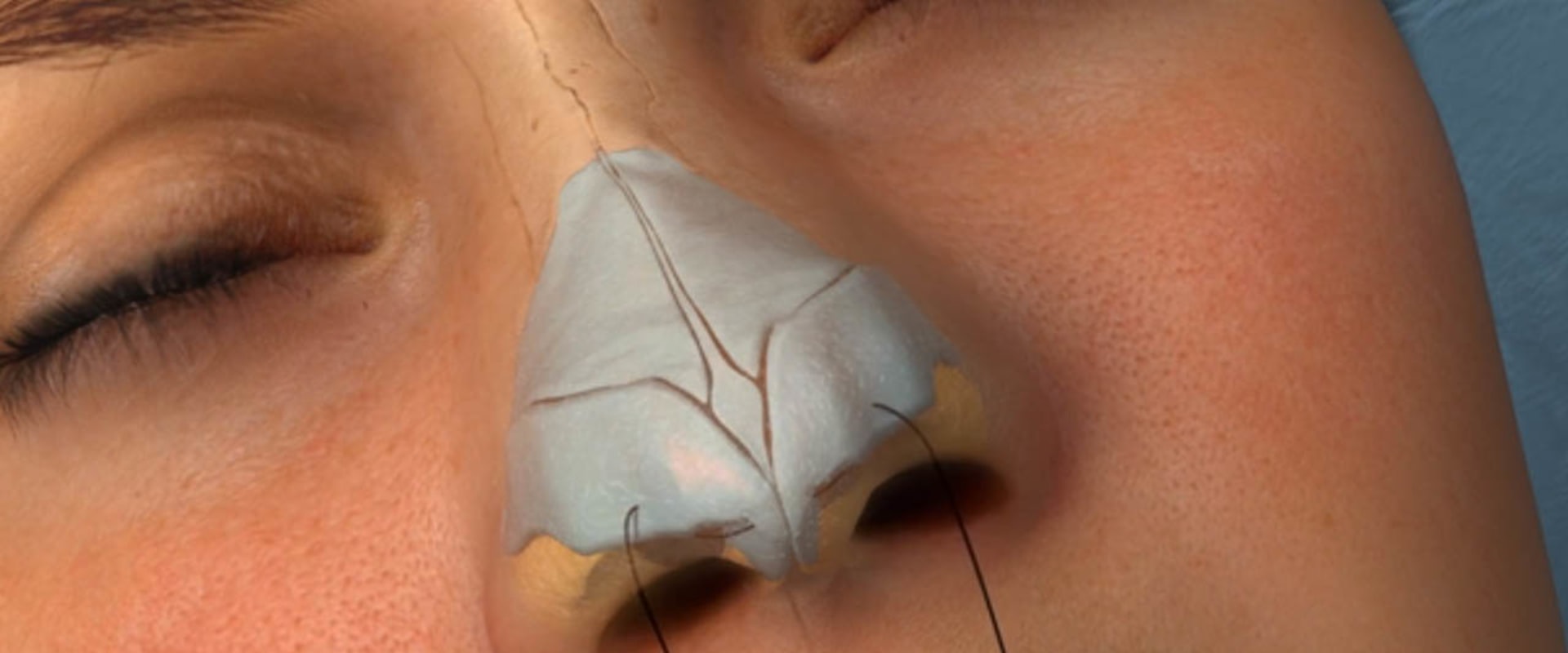 The True Cost of Rhinoplasty: What You Need to Know