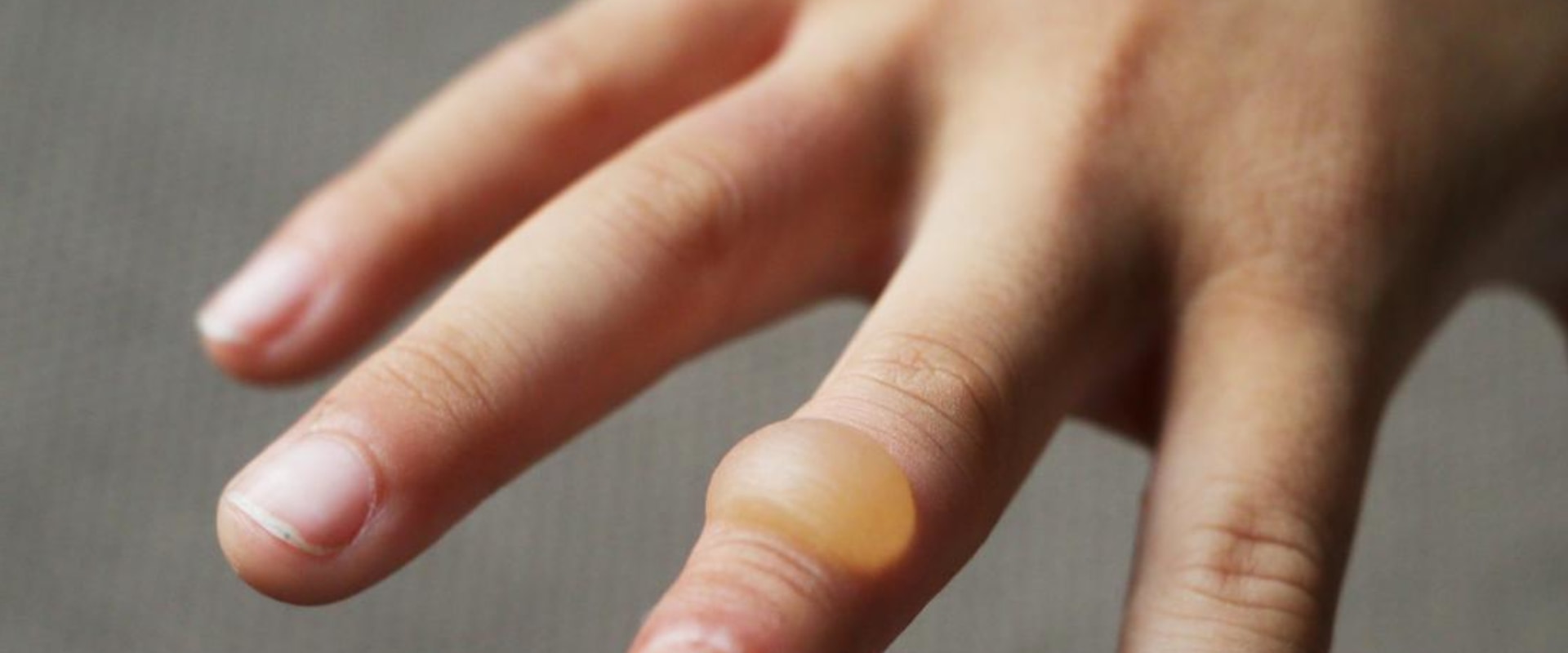 Discovering the Stages of Burn Blister Healing