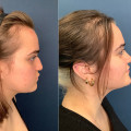 The Truth About Non-Surgical Nose Reshaping: What You Need to Know