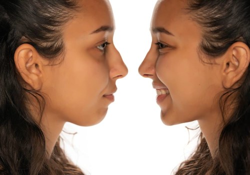 The Truth About Nose Jobs: An Expert's Perspective